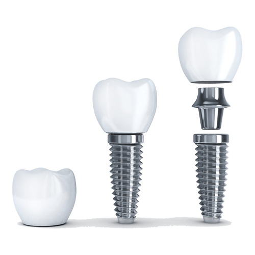MasterX Implant