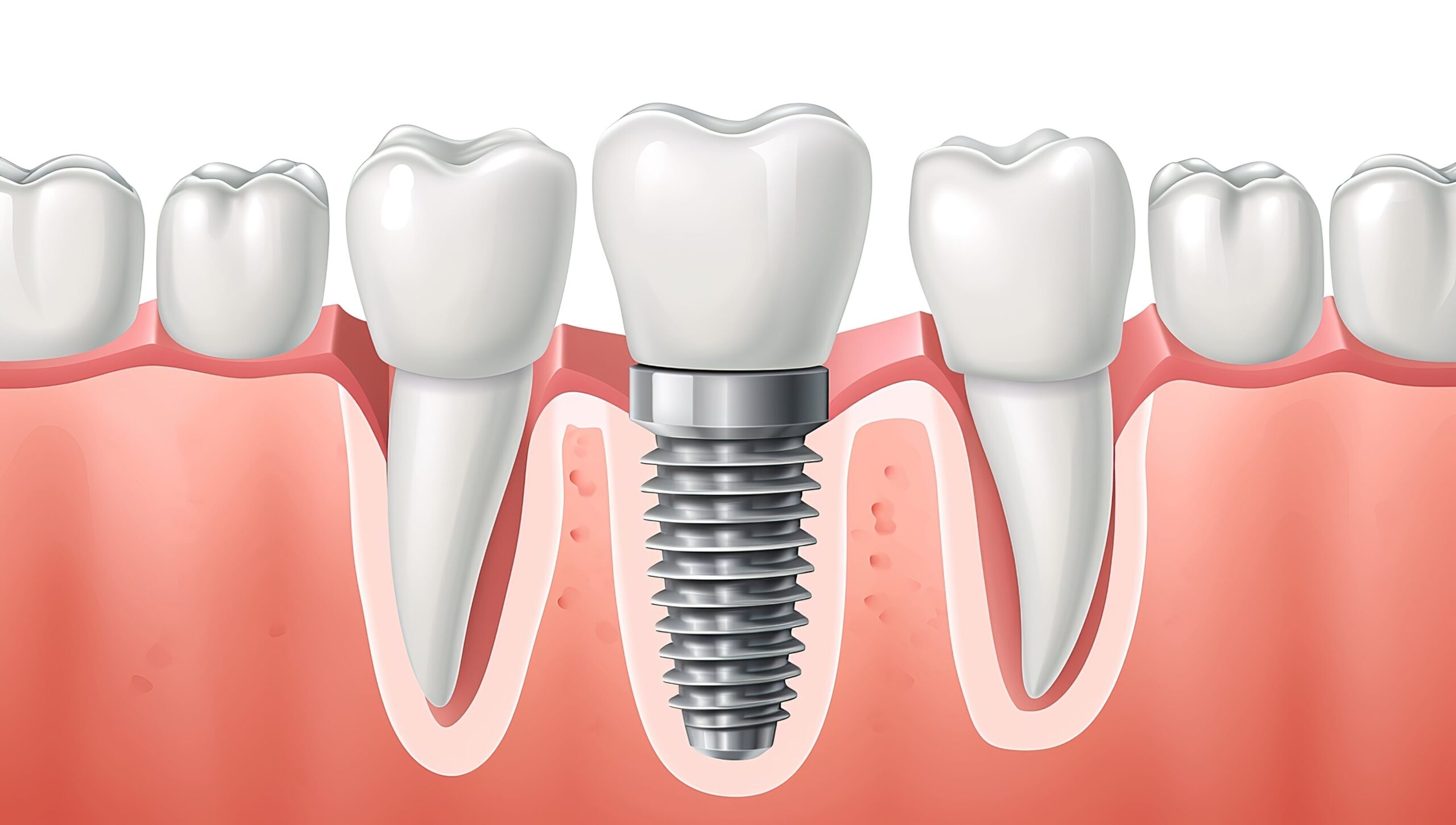 MasterX Implant